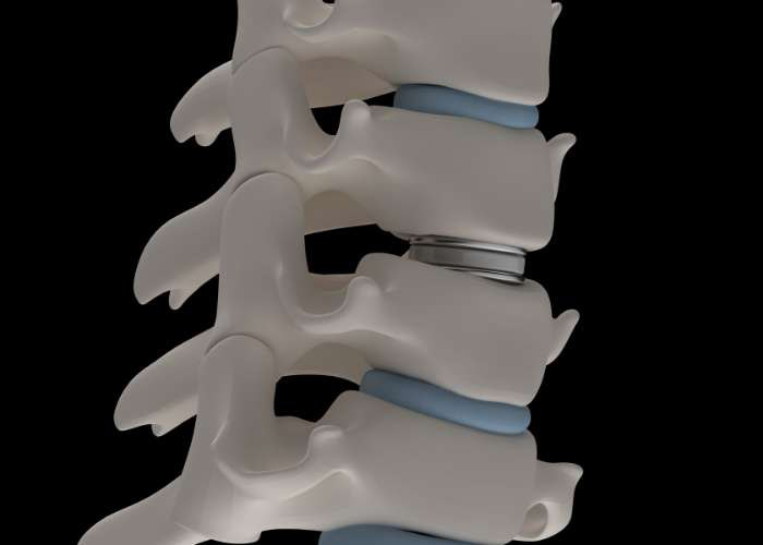 Cervical Artificial Disc | St. Louis MO