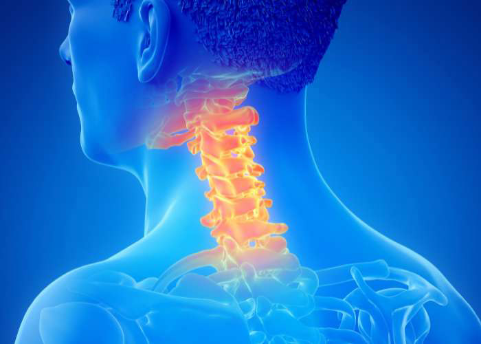 Cervical Posterior Decompression and Fusion